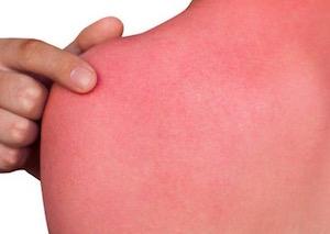 Sonnenbrand, Quelle: istockfotos